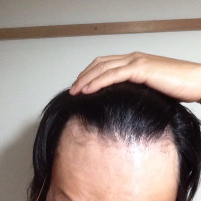 Agaの四十路おじさん 韓国自毛植毛 挑戦記録 うみかぜ Taiyo103pi Twitter