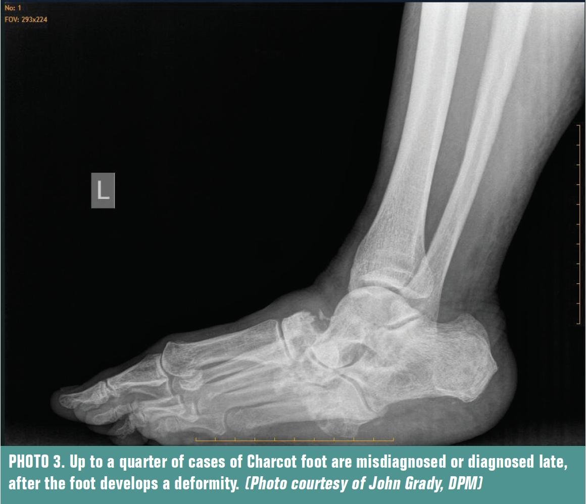 FootCharcot's profile picture. Charcot Foot Support is devoted to helping those living with Charcot Foot. We do so by providing support, education and resources.