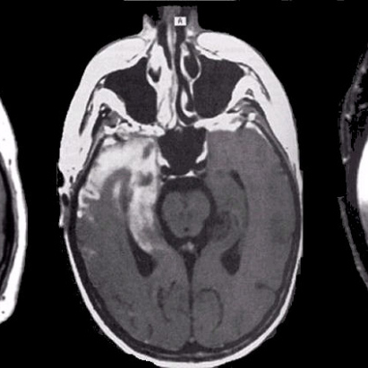 Auto-Immune Encephalitis person. Woke up, didn't know who I was. Gradually getting to know Tony again....