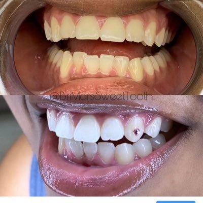 CERTIFIED‼️ Teeth Whitening!🦷✨ Tooth Gems!🦷💎 Training Packages Available! 🎯 WE TRAVEL TO ANY STATE 🛫