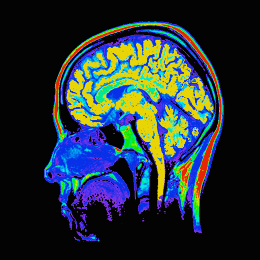 The CCNC and MIND programs conduct research on the impact of cannabis on the brain at the McLean Hospital Imaging Center