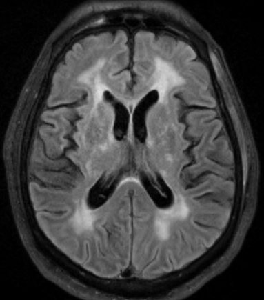 We study shared molecular mechanisms between Alzheimer's disease and Cerebral Amyloid Angiopathy