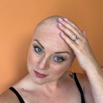 My journey with trichotillomania. Acceptance. Hair systems, wigs, SMP, head tattoo & being bald 👩🏻‍🦲