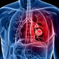 Glenfield Thoracic Surgery (@surgerythoracic) Twitter profile photo