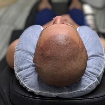 NuHair Ink introduces some of the latest hair loss solutions. Go for our advanced Scalp micro-pigmentation that will put a stop to your hair loss problems. Our