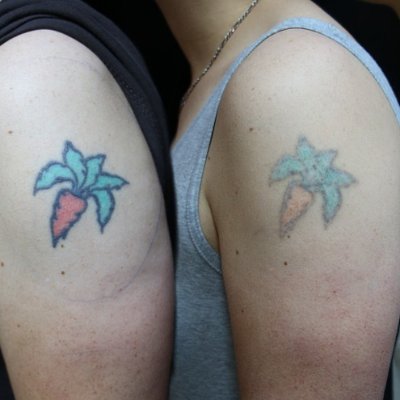 Tattoo removal treatment options