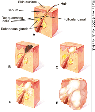 My name is  Nastase C.A. I show you how to kill your acne.