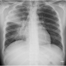 Asociación de Apoyo e Información a Familiares y Pacientes con Neumonía, nacimos para concienciar sobre la neumonia, escuchar y educar #neumonia #pneumolight