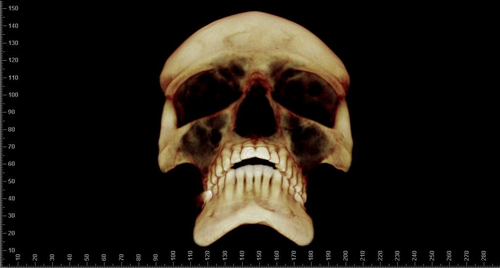 Cirurgia Ortognática
Orthognathic Surgery