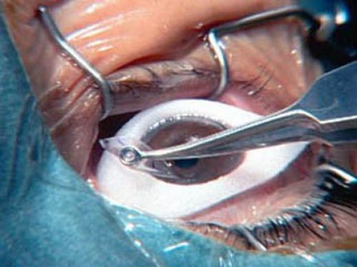 All about Laser Eye Surgery: videos, pics, articles and solutions. Interwiews to the most prestigious surgeons and ophthalmogists of the world.