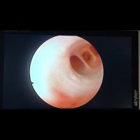 laparoscopic common bile duct exploration (@bilecommon) 's Twitter Profile
