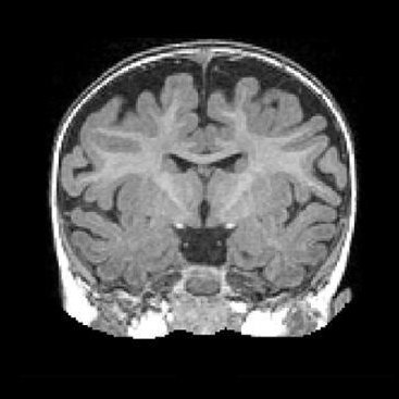 Studying infant brain development. Babies needed! Recruiting infants who have an older sibling with autism.