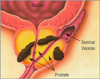 Just because a person is old, he should not be prevented from receiving treatment for prostate cancer.