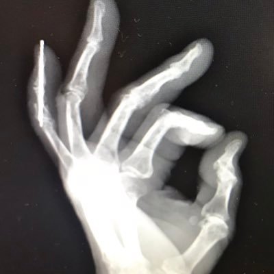 My x-ray OK sign is from when I nearly cut off my pinky, you can see the pin inserted by my surgeon.  I identify as mostly male mostly white mostly human.