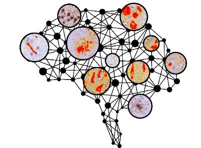 We elucidate the clinical-pathologic correlation of FTD, ALS, PD, AD to develop new tests to detect pathology earlier in living patients @Penn @PennMedicine