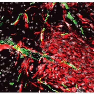 #braintumors #brainmetastases #gliomas #drugtargeting #universityofhelsinki #preclinicalmodels #phagedisplay #metastaticdissemination