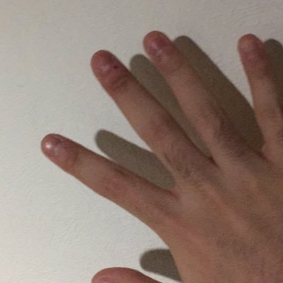 爪噛み克服アカ Skt6xwpto2x8jgm Twitter