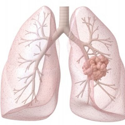 mesothelioma and nsclc