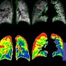 PolareanImaging's profile picture. A leader in the field of lung imaging.  Polarean (AIM: POLX) has successfully developed the first and only FDA approved hyperpolarized MRI contrast agent.