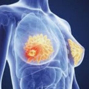 Breast Cancer effects 1in8 Women. HER2+effects 1in5 so 15% to20% will test positive with this more aggressive gene mutation
Let's share Our unexpected Journey