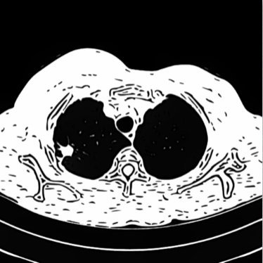 Lung Cancer Screening Feed Profile