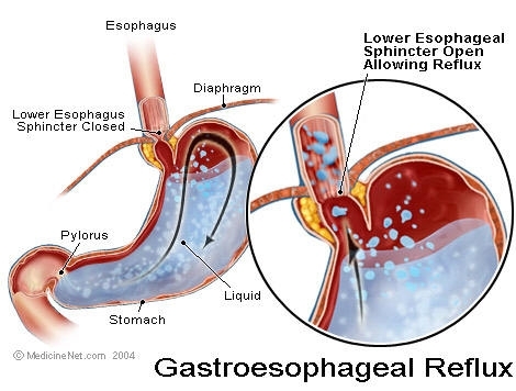 Learn how to cure Acid Reflux, , learn the various acid reflux natural treatment options as well as know the symptoms and cause of acid