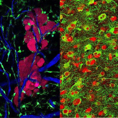 Understanding and targeting the neurobiology of brain tumors and beyond in space and time @uniklinik_hd @DKFZ  @Winkler_Lab@neuroscience-mastodon.com