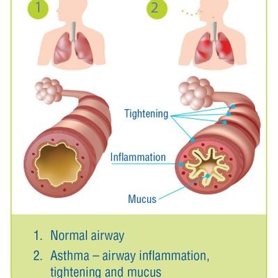 This initiative is focused on providing People Living-with Asthma In Nigeria (P.L.A.I.N) with timely AID through Research, Advocacy, Interventions & a Network.