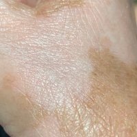 Vitiligo NewsNetwork (@vitiligonewsnet) 's Twitter Profile