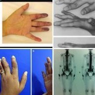 1K+🔗🔗to case reports show #Rheumatoid #Arthritis'/chron #polyarthritis' endless list of DDx, long&thin tailed: https://t.co/ijStzKkv8M