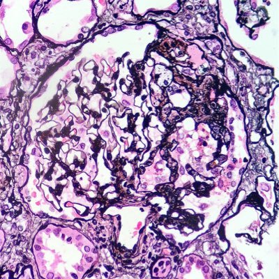 NephroPath's profile picture. Non-Neoplastic and Transplant Renal Pathology 🔬