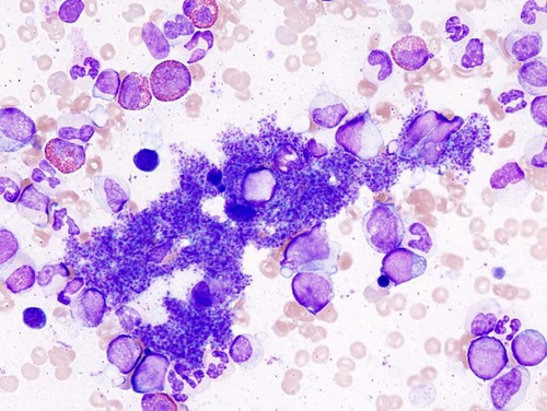 A blog containing information about, and my experiences as a patient with, Essential Thrombocythemia.