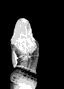 Pearly Penile Papules Removal