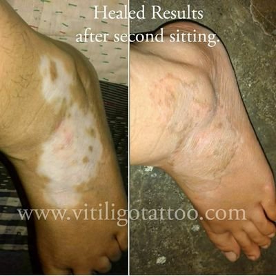 VitiligoMicrop1's profile picture. Vitiligo Micropigmentation & Scar Camouflage.
https://t.co/5Q987GhXG2
Seawoods, Navi Mumbai