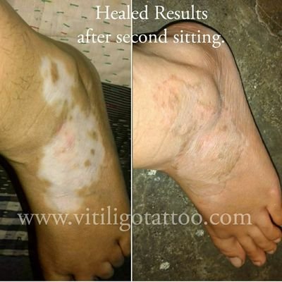 Vitiligo Micropigmentation & Scar Camouflage.
https://t.co/5Q987GhXG2
Seawoods, Navi Mumbai