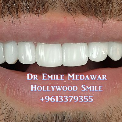 Hollywood Smile Lebanon, Dr Emile Medawar, Cosmetic Dentist, Dental Implants Surgeon, Oral Surgery Specialist, 00 961 3 379355, 00 961 081774