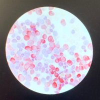 Grup de Recerca Translacional Hematologia_GRETNHE (@gretnhe) 's Twitter Profile