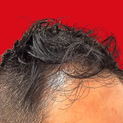 40歳からの毛髪復活を目指し、トヨタ式改善方式なぜなぜなぜなぜなぜ、ならぬハゲハゲハゲハゲハゲを繰り返す男。