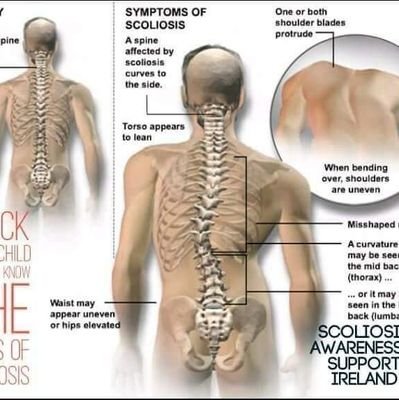 Supporting and advocating for  families living with Scoliosis in Northern Ireland
@support_ireland