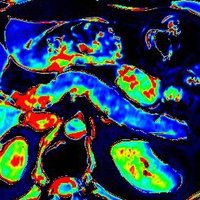 SAR Pancreatitis Disease Focus Panel (@pancreatitisdfp) 's Twitter Profile Photo SAR Pancreatitis Disease Focus Panel (@pancreatitisdfp) 's Twitter Profile Photo