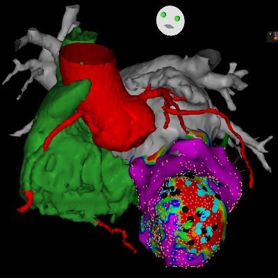 Unidad de Arritmias Hospital Universitario Puerta del Mar | “Flowing the rhythm of the heart”