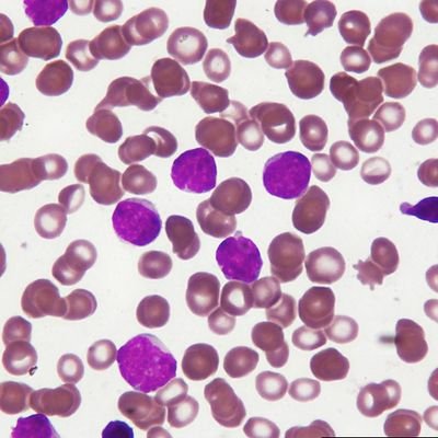 Blood Hematology Spot Diagnosis