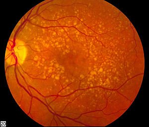 Latest clinical and research news in the field of age-related macular degeneration.