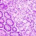 DigestivePathJC (@gipathjc) Twitter profile photo DigestivePathJC (@gipathjc) Twitter profile photo