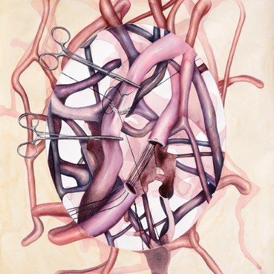 Surgery is anatomy. Anatomy is geometry. Geometry is the heart of mechanics. @UChicagoAorta @UChicagoSurgery @PittSurgery @UChicago Artwork by Vesna Jovanovic