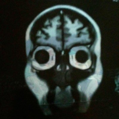 Describo como es mi vida con un tumor en la yugular/cerebral. Tengo problemas de inmunidad. #HagamosComunidad Ya tengo Facebook 💚💜💙♿