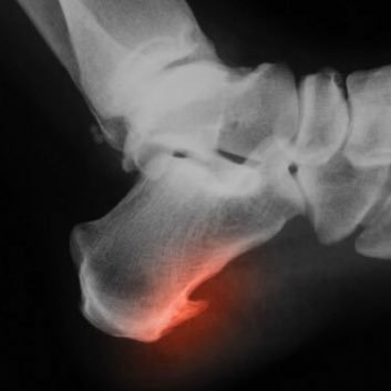 Cadet Bone Spurs’ literal bone spurs.