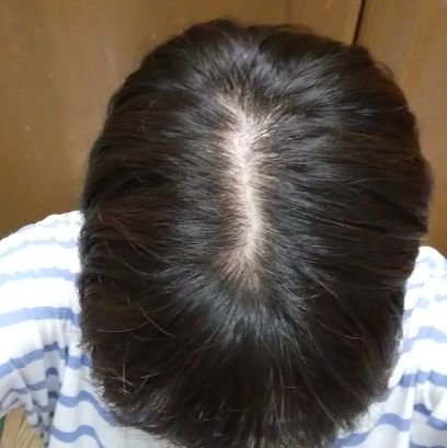 薄毛ちゃん 絶対に髪を増やすぞ Gtqwezhbnl13hza Twitter 薄毛ちゃん 絶対に髪を増やすぞ Gtqwezhbnl13hza Twitter