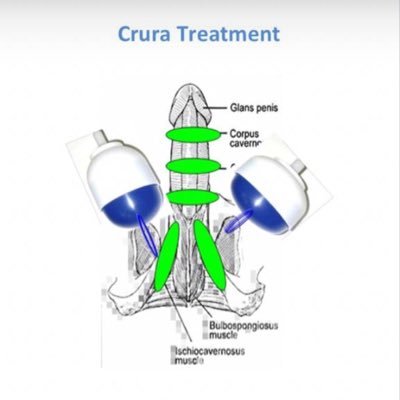 ErectileTherapy's profile picture. ED is a complication of Diabetes in men. My therapy positively impacts the erectile function of men living with diabetes &/or hypertension, one shock at a time