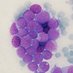 Hematologia ICO Badalona - Germans Trias i Pujol (@hematocanruti) Twitter profile photo Hematologia ICO Badalona - Germans Trias i Pujol (@hematocanruti) Twitter profile photo